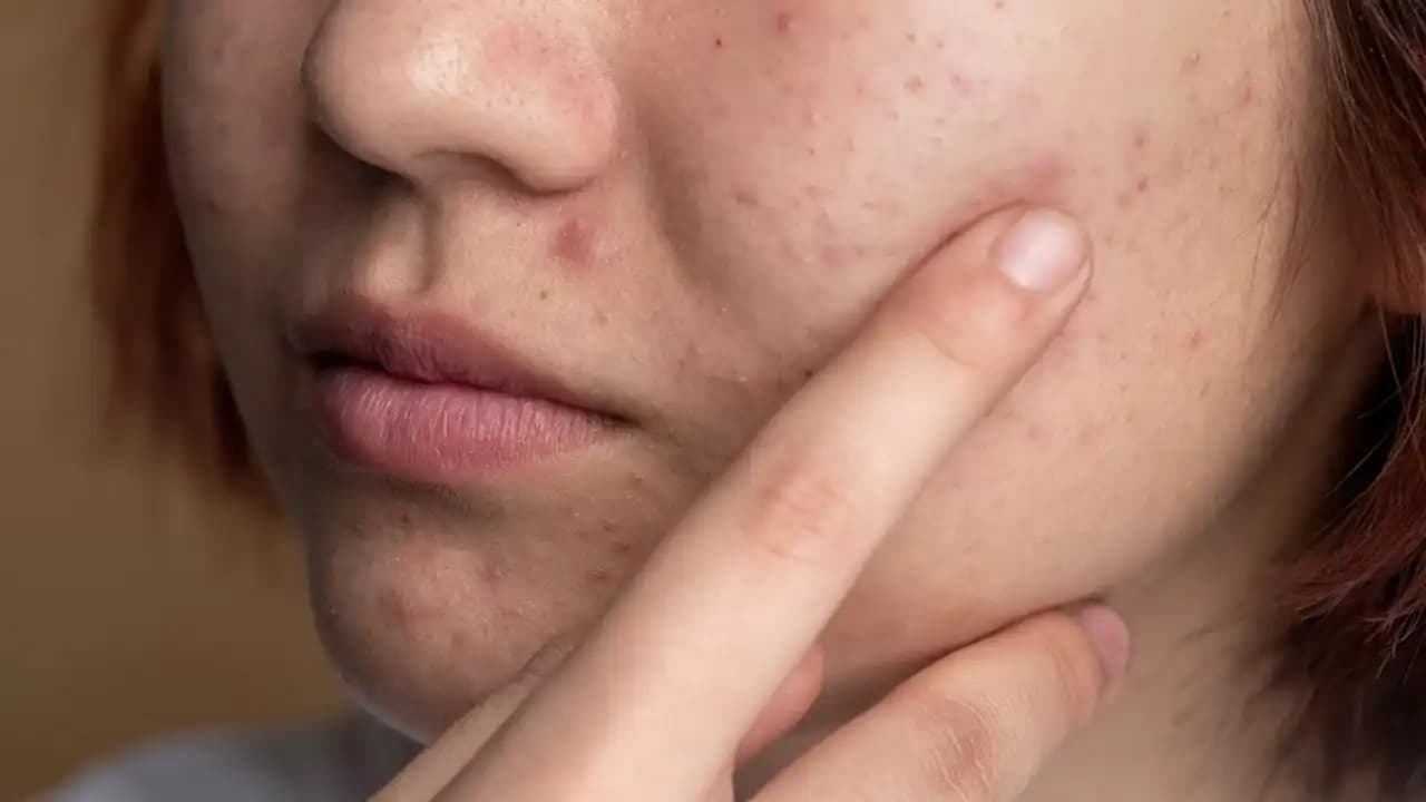 Çocuklarda Sivilce: Nedenleri, Belirtileri ve Doğru Bakım Yöntemleri