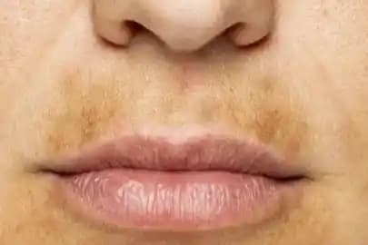 Dudak Lekeleri Nedenleri Türleri ve Etkili Çözüm Yolları Hakkında Kapsamlı Bilgi