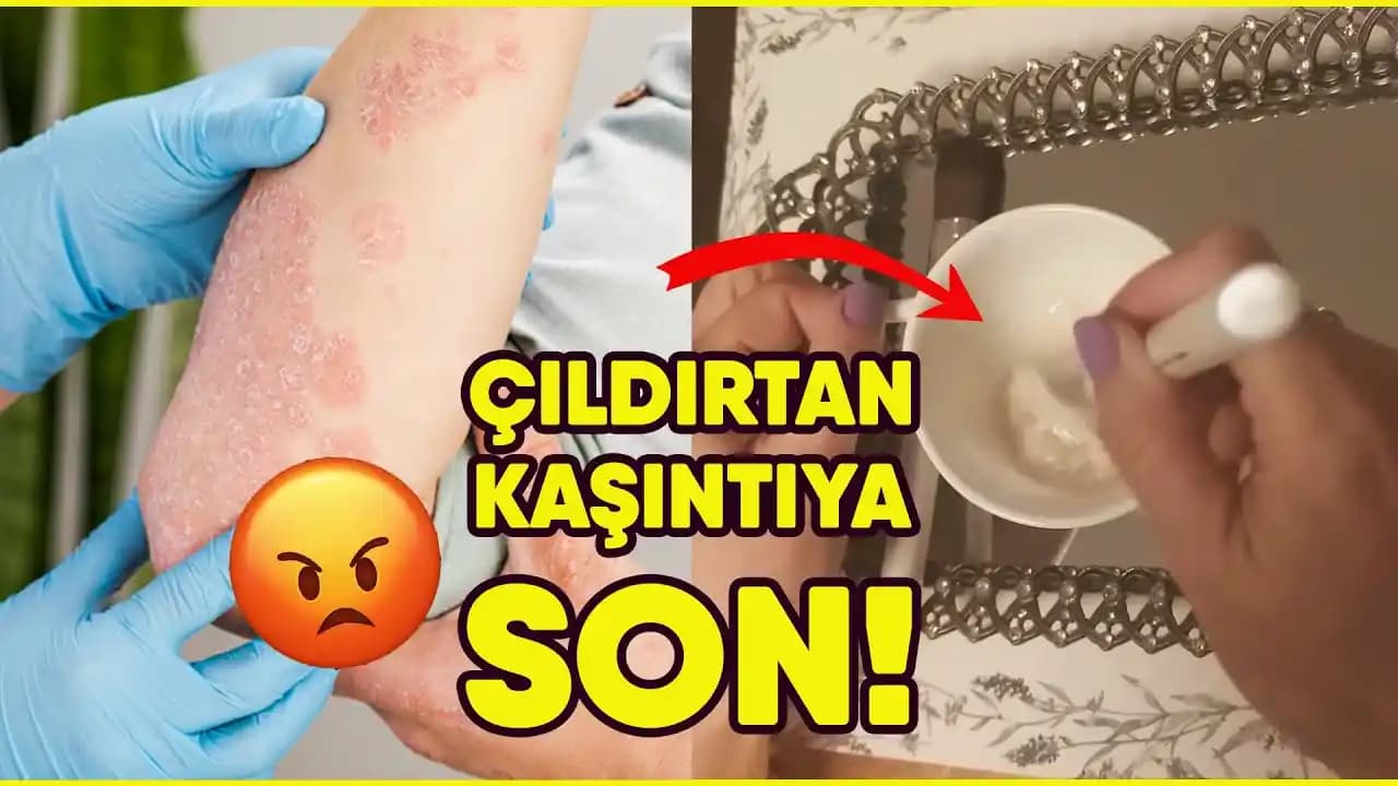 Kaşıntıya Karşı Evde Uygulanabilecek Doğal ve Güvenilir Çözüm Yöntemleri