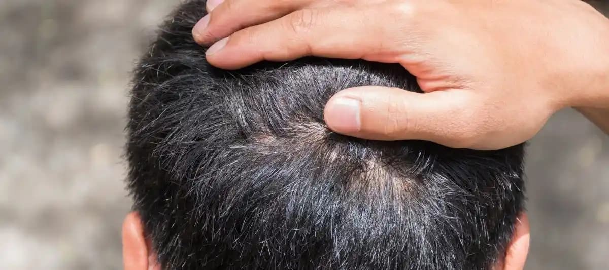 Saç Derisinde Kaşıntı ve Rahatsızlıkları Giderici Yöntemler ve Bakım Tavsiyeleri