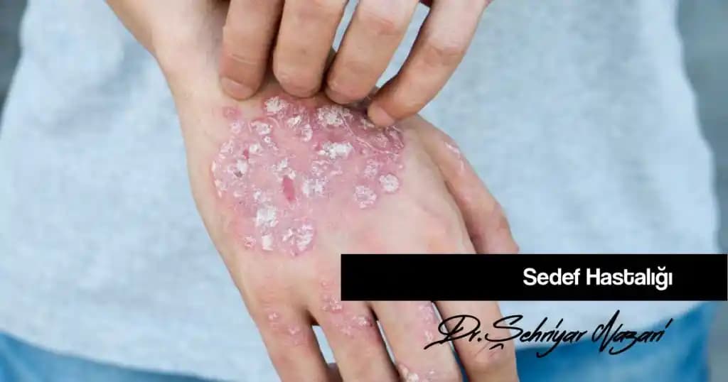Sedef Hastalığında Kaşıntı ve Rahatlama Yöntemleri Hakkında Bilgiler