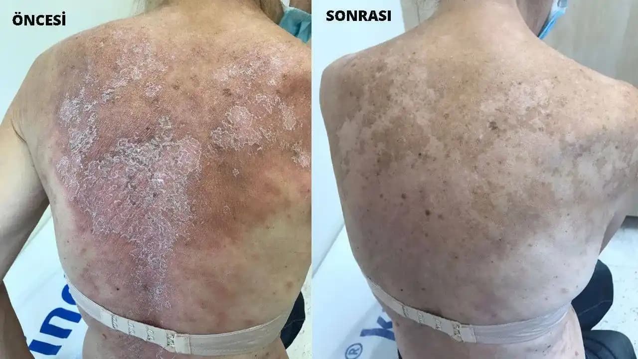 Vücutta Kızarıklık Nedenleri, Belirtileri ve Çözüm Yolları Hakkında Detaylı Bilgi