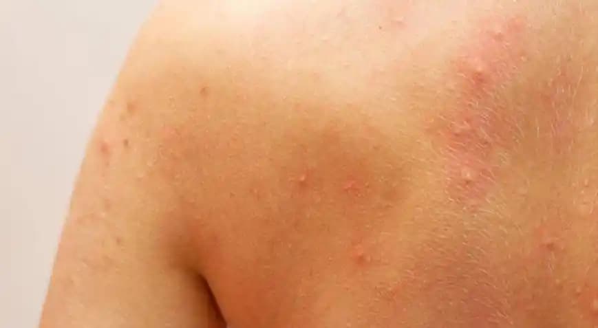 Vücutta Kızarıklık ve Kaşıntı Nedenleri ile Doğal ve Kozmetik Çözüm Yöntemleri