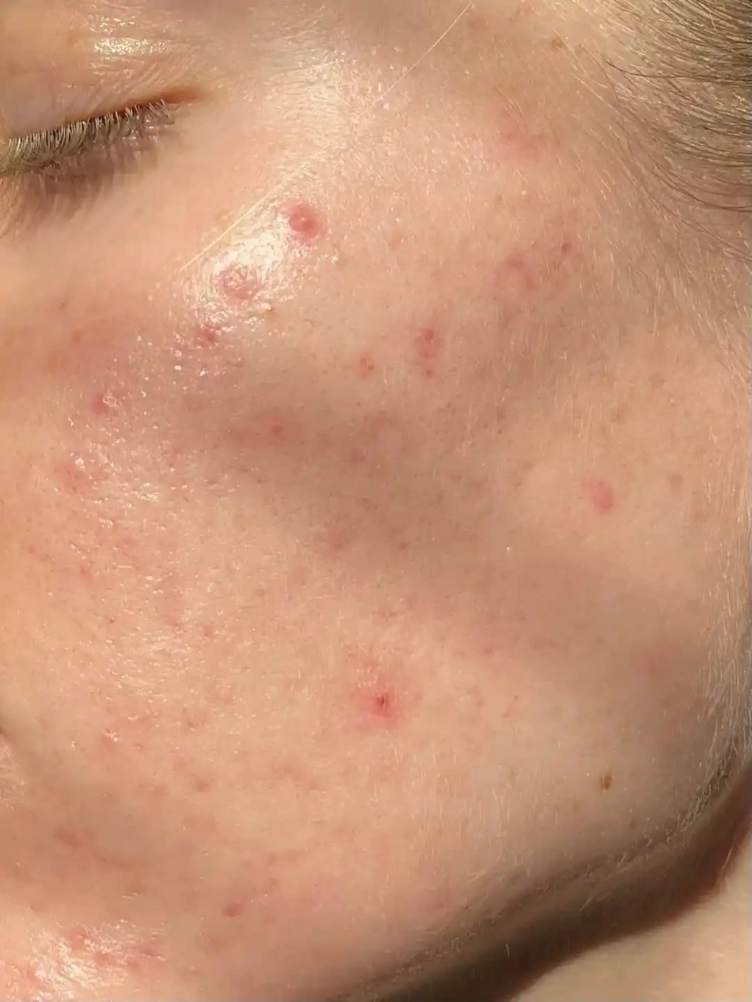 Akne Tedavisinde Cilt Bakımı ve Bariyer Koruma Yöntemleri Üzerine Detaylı İnceleme