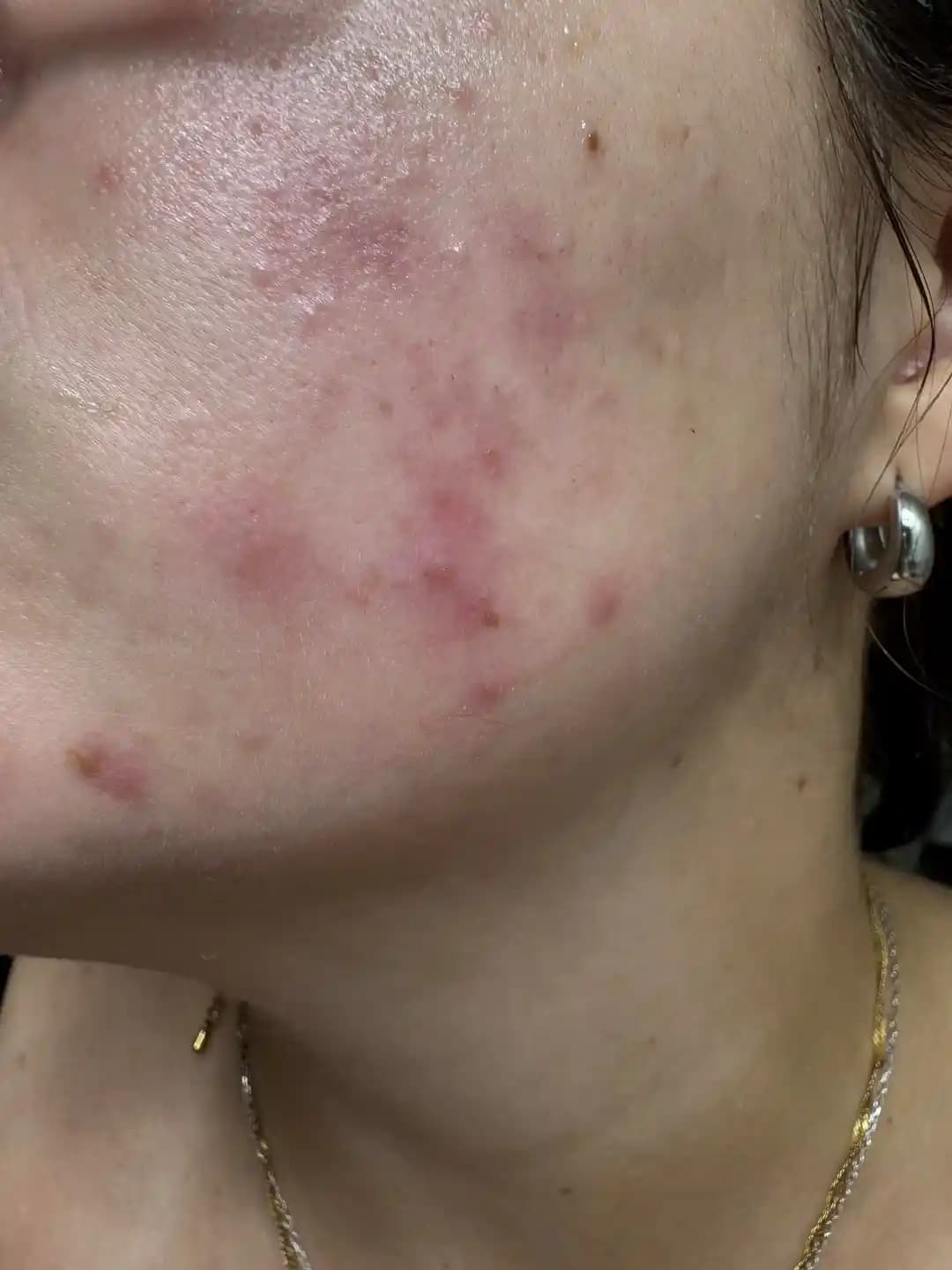 Cilt Altı Sivilceleri: Hormonal Dengesizlikler ve Alerjik Faktörlerin Tedavi Yöntemleri