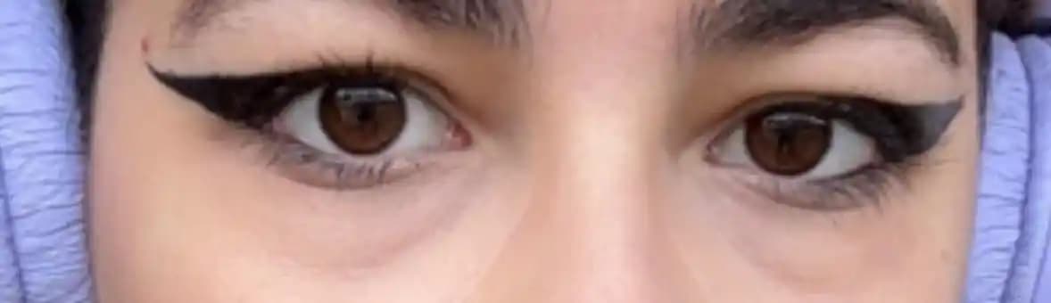 Göz Altındaki Çizgiler: Nedenleri, Estetik Anlamları ve Tedavi Yöntemleri