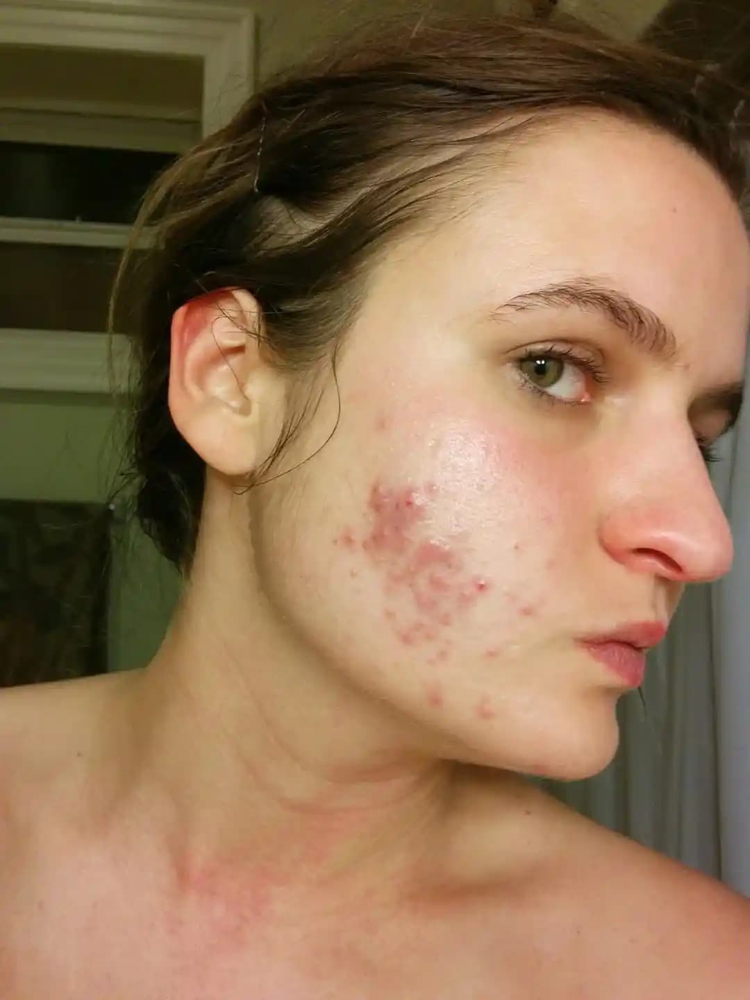 Kistik Akne İzlerinin Doğal Yolla İyileştirilmesi İçin Etkili Cilt Bakımı ve Sabır